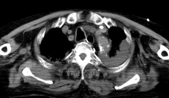 胸腹部CT・血胸